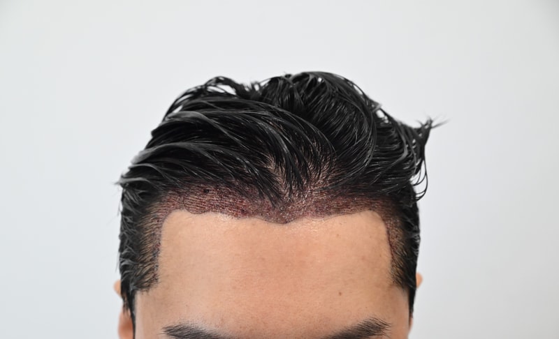 Hair Transplant Day 1 Review (MoM)