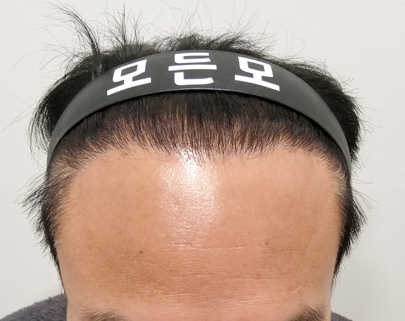 6. 수술후_1년_1.jpg