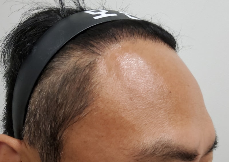 6. 수술후_1년_3.jpg