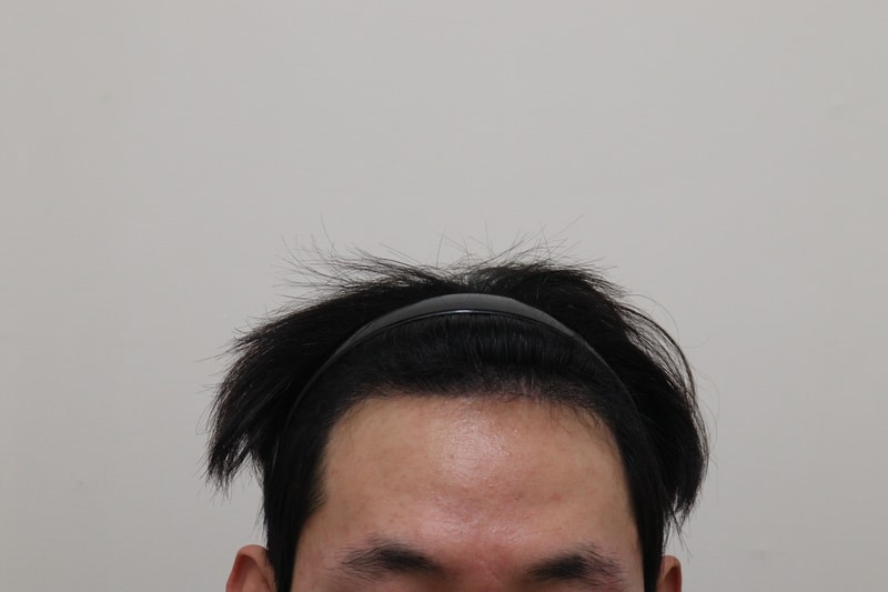 3. 수술후_6개월_1.JPG