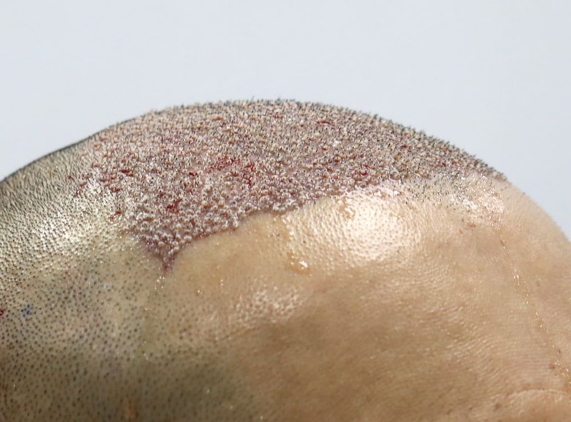 7.수술당일.JPG