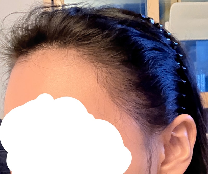 다나 4400모 여성 모발이식 7개월 10000% 만족 후기
