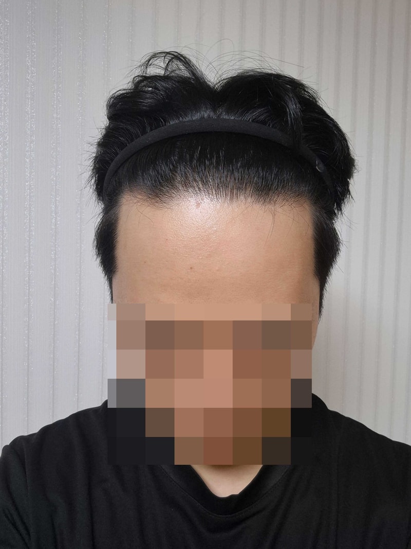 제가 모발이식을 추천하는 이유ㅎㅎ 다나에서 비절개이식 19개월째