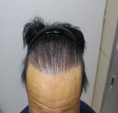 수술후.png