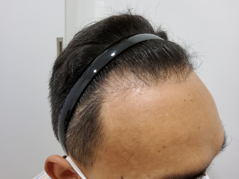 1. 수술전_3.jpg