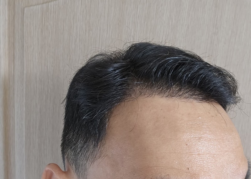 4. 수술후_6개월_셀카_2.jpg