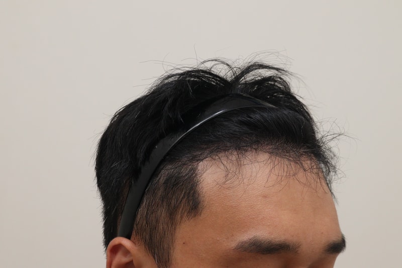 3. 수술후_6개월_4.JPG