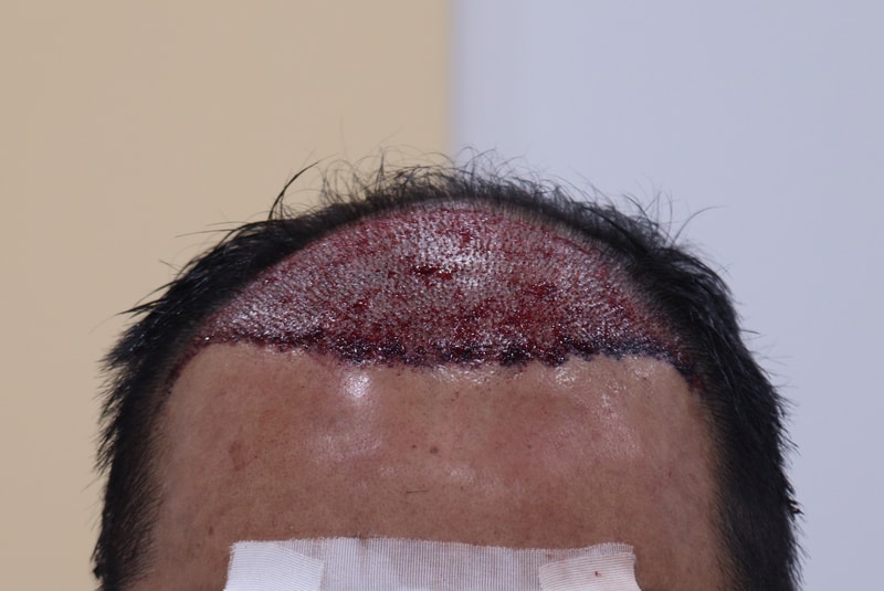 2. 수술후_당일_1.JPG