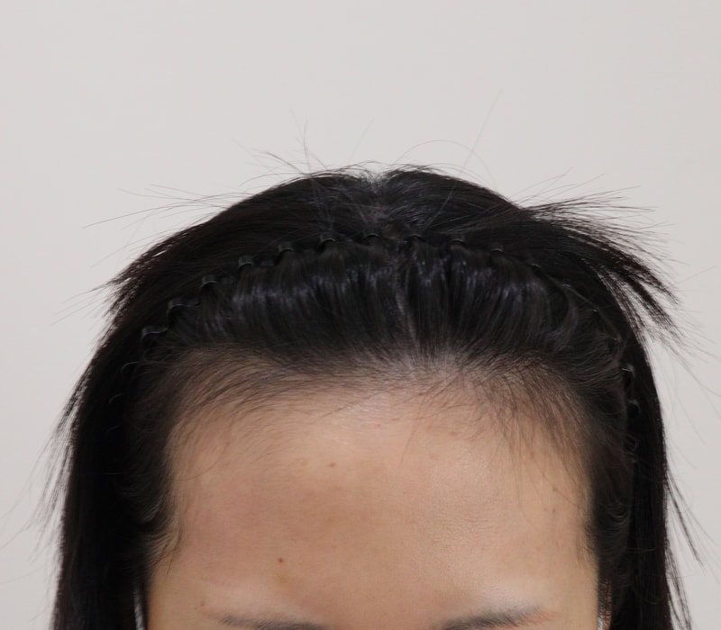 1. 수술전_1.JPG