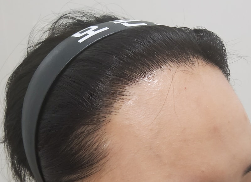 5. 수술후_1년_3.jpg
