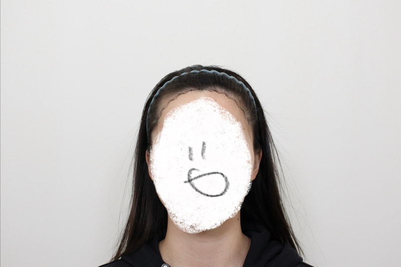 신사역 모프로의원 문건학원장님 - 헤어라인 모발이식 3259모 상담