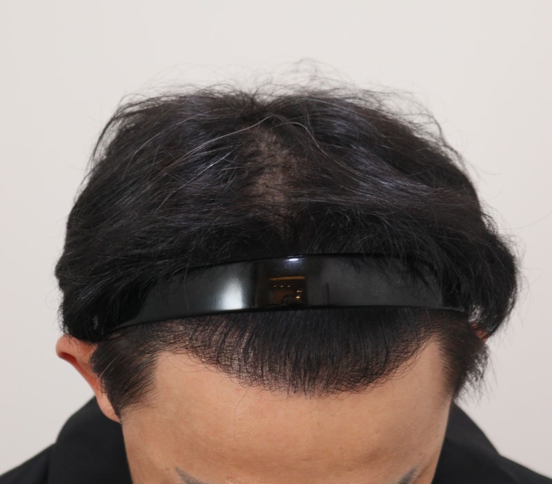 4. 수술후_1년_2.JPG