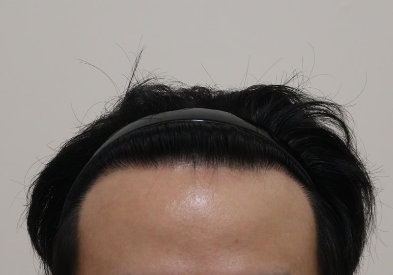 4. 수술후_1년_1.JPG