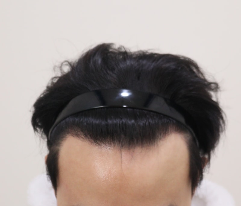 4. 수술후_1년_2.JPG
