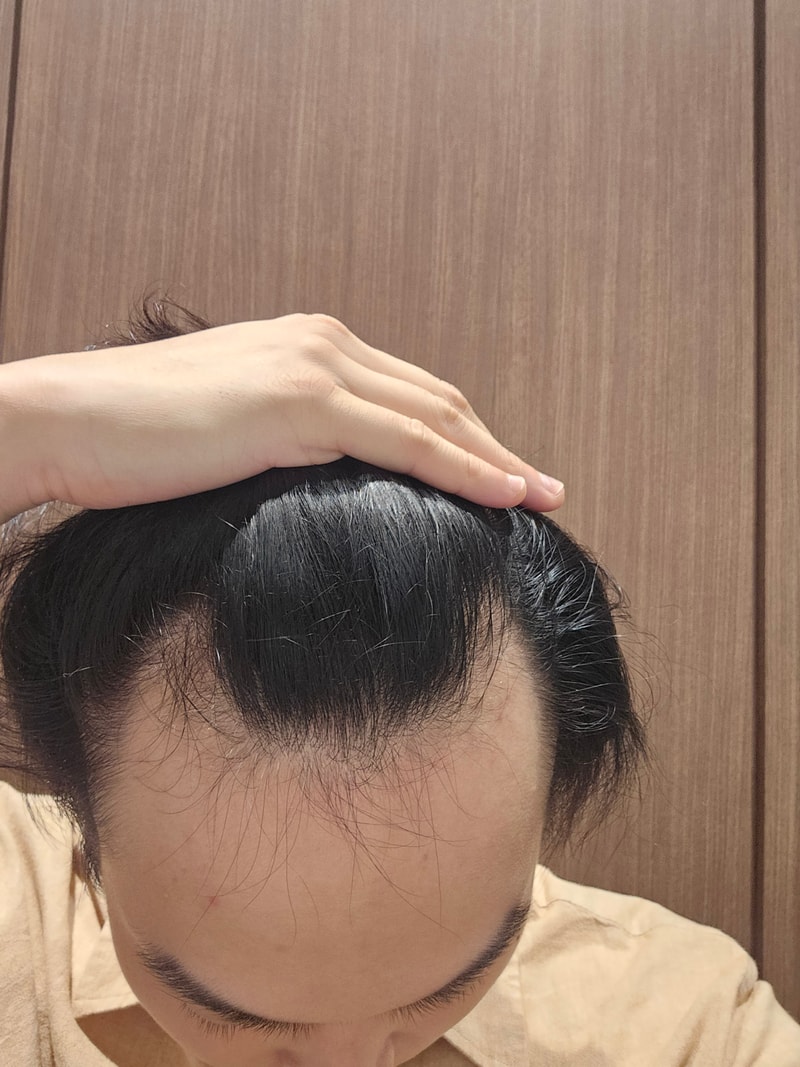 모원성형외과 m자이마 무삭발 비절개 모발이식 1500모낭 3개월차 후기
