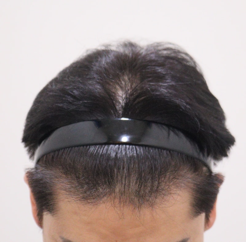 4. 수술후_1년_1.JPG