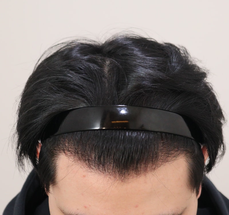 3. 수술후_1년_2.JPG