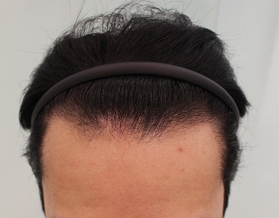 报告M字移植第6个月。