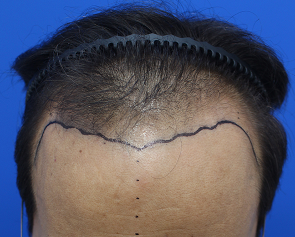从额头开始一直往上爬到头顶 接受了毛发移植治疗