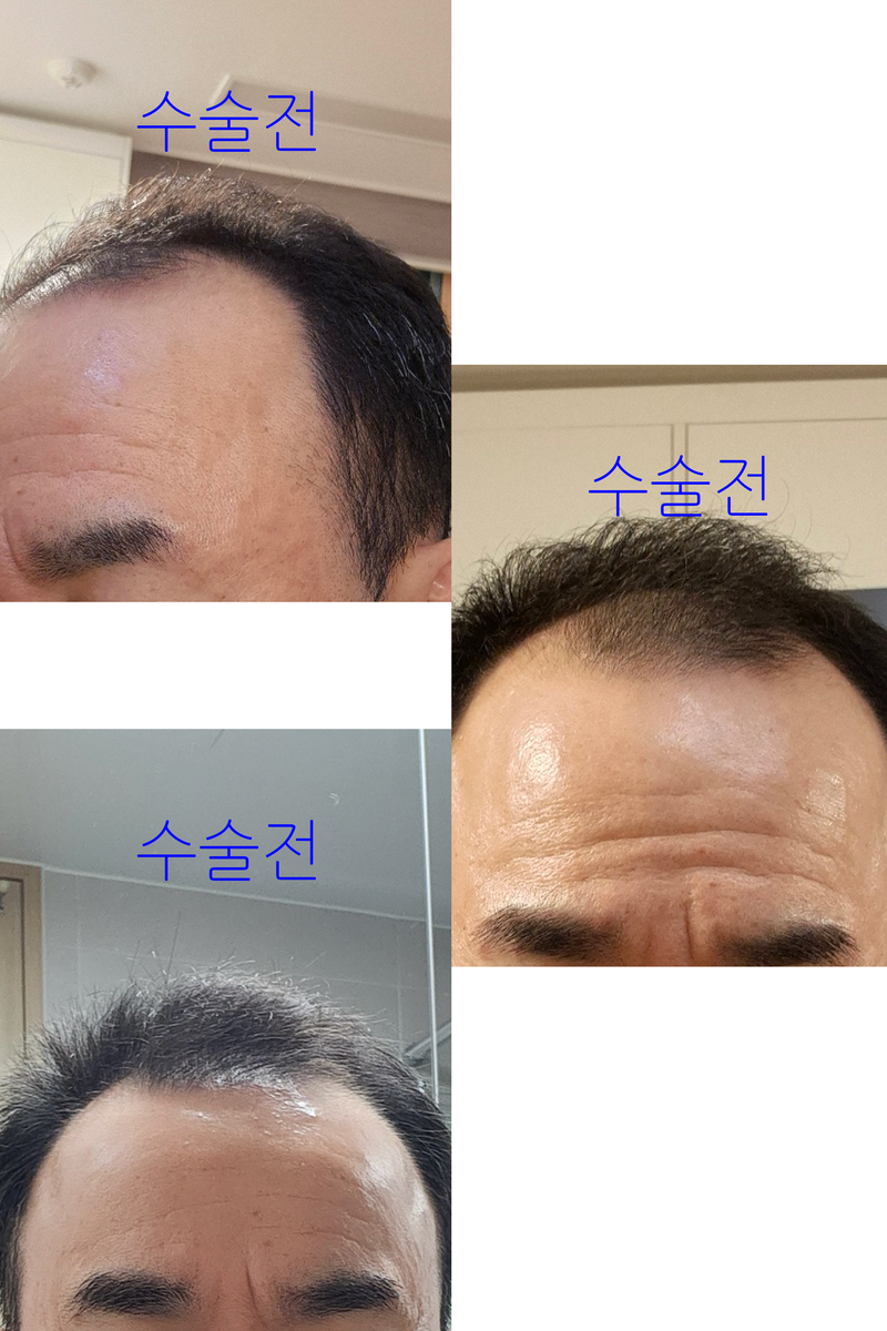 +수술전.png