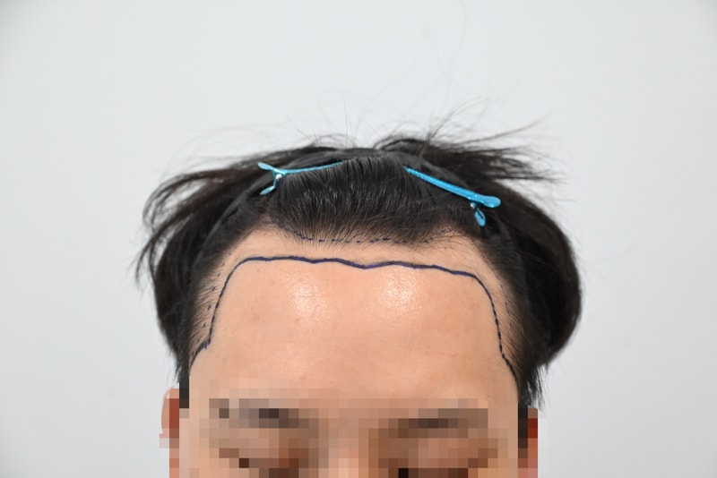 비절개 3400모 직후 포토 후기