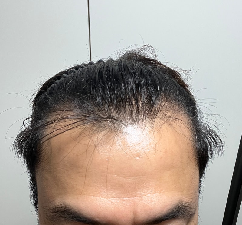 M자 절개 5일차