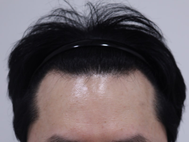 1. 수술전_1.JPG