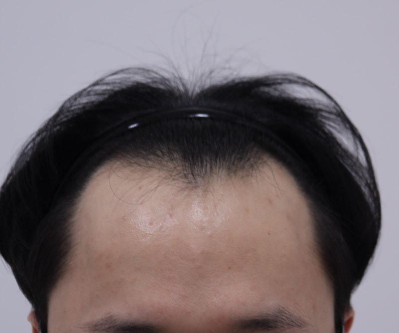 1. 수술전_1.JPG