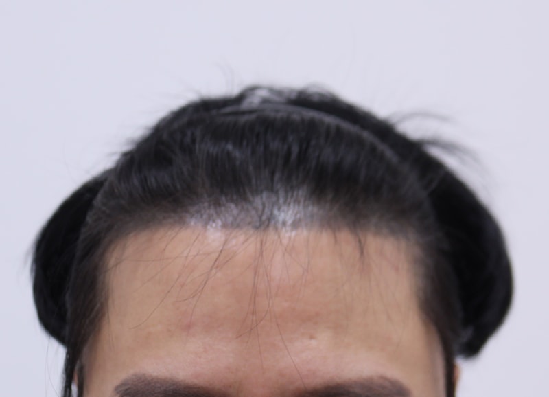 1. 수술전_1.JPG
