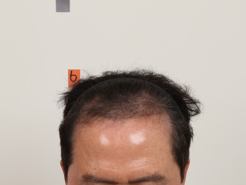부산모발이식 슬릿방식 맘모스 깊은 M자 4개월!