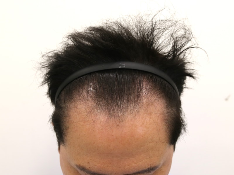 1.수술전.jpg
