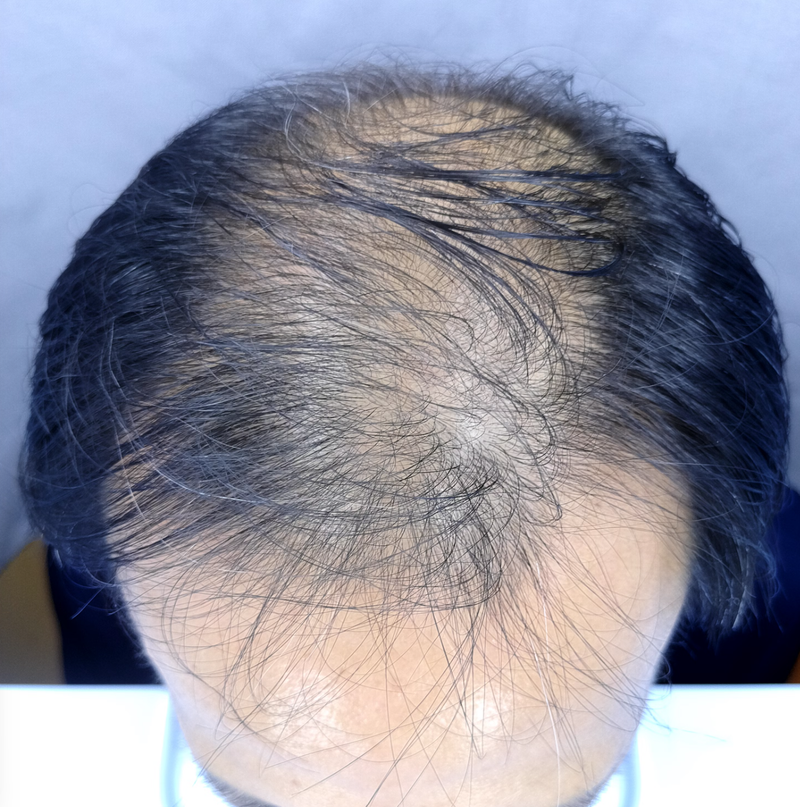 김형준67 4000모이식전 아프스2.png