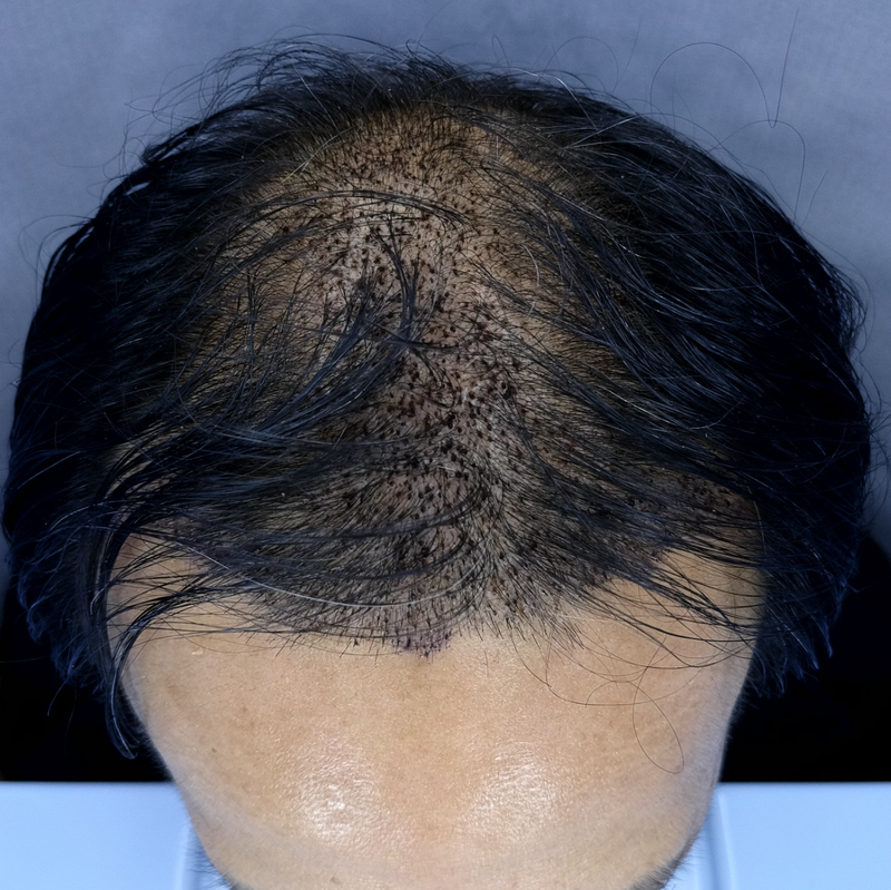 김형준67 4000모이식후 아프스.png