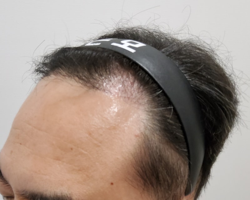 3. 수술후_3개월_2.jpg