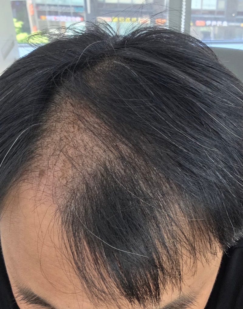 시술 후 36일째.. 머리가 계속 빠지고 있음(암흑기라..)