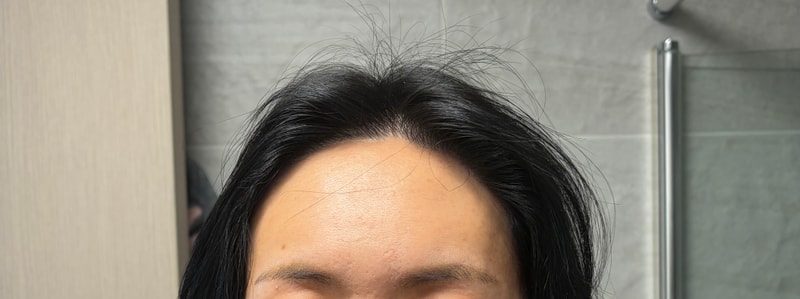 헤어라인 이식 10개월 후기