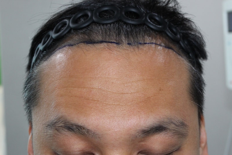 시술 전(정면).jpg