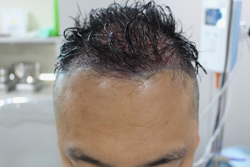 수술 당일(정면).jpg