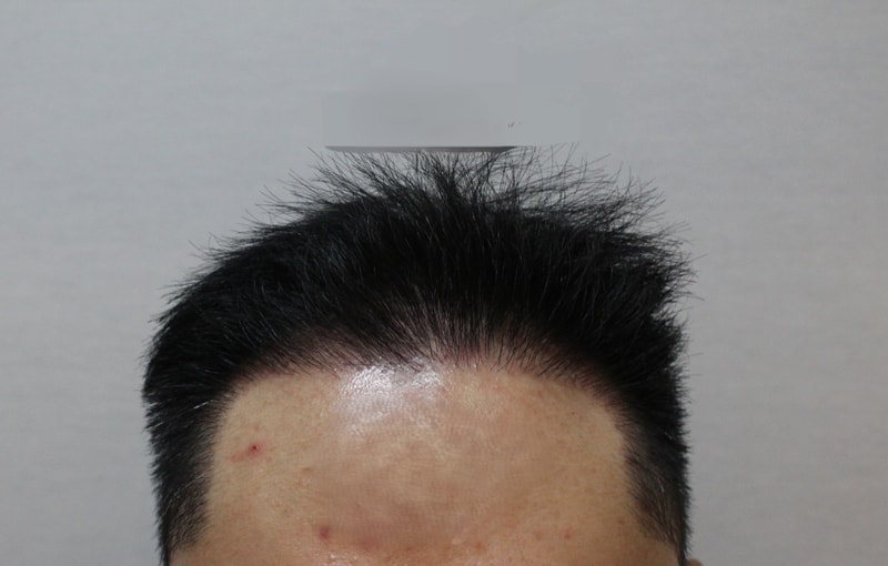수술후1년차.jpg