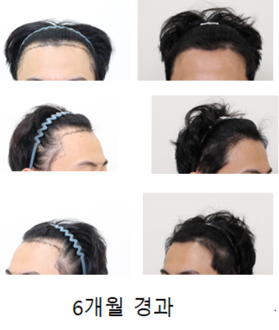 신사★모프로의원,모발이식,재수술,약 6개월