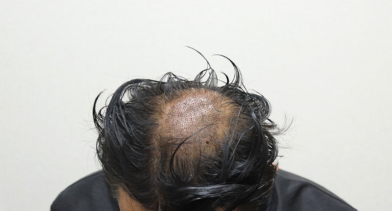 04. 수술다음날 정수리 IMG_2925.JPG