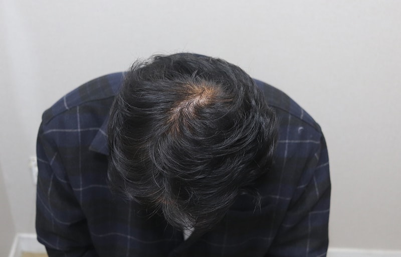 7. 6. 1년10개월 경과 (정수리).JPG