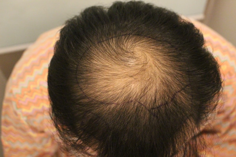 It's been 4 months since the top of the head hair transplant.