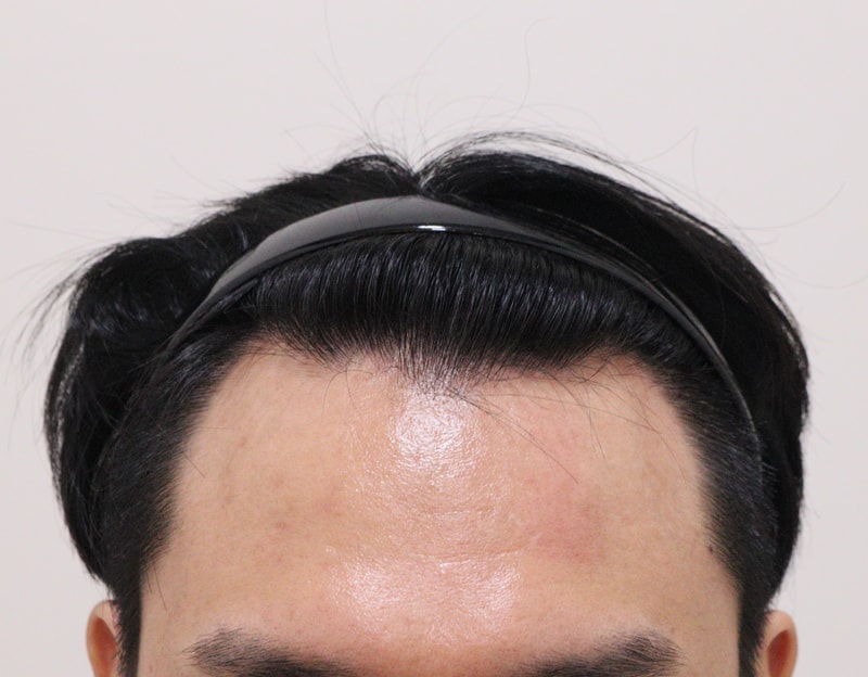 1. 수술전_1.JPG