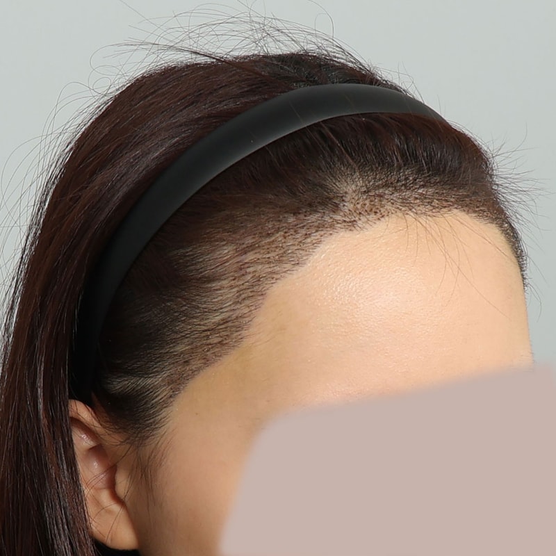 수술 후 13일차 (2).jpg