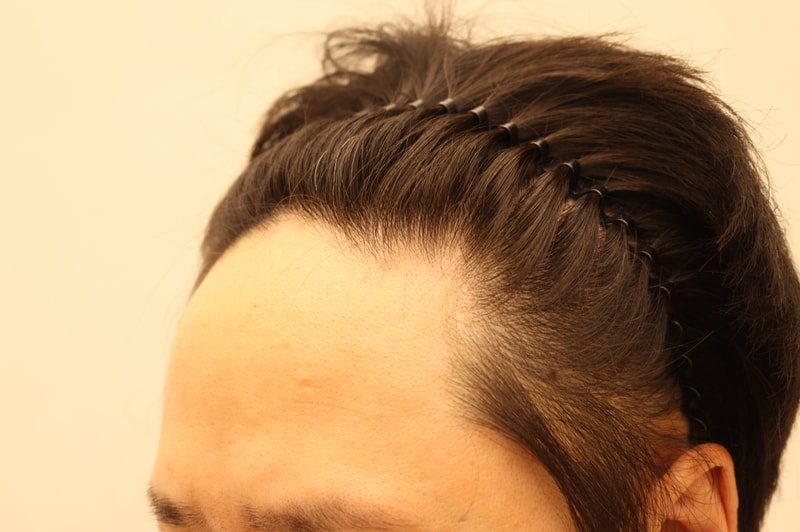 1.  수술전_2.JPG