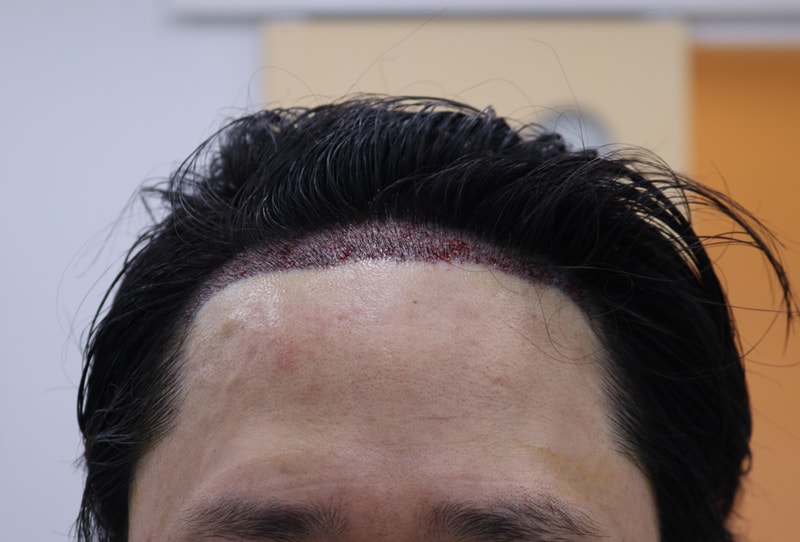 2. 수술후_1일_1.JPG