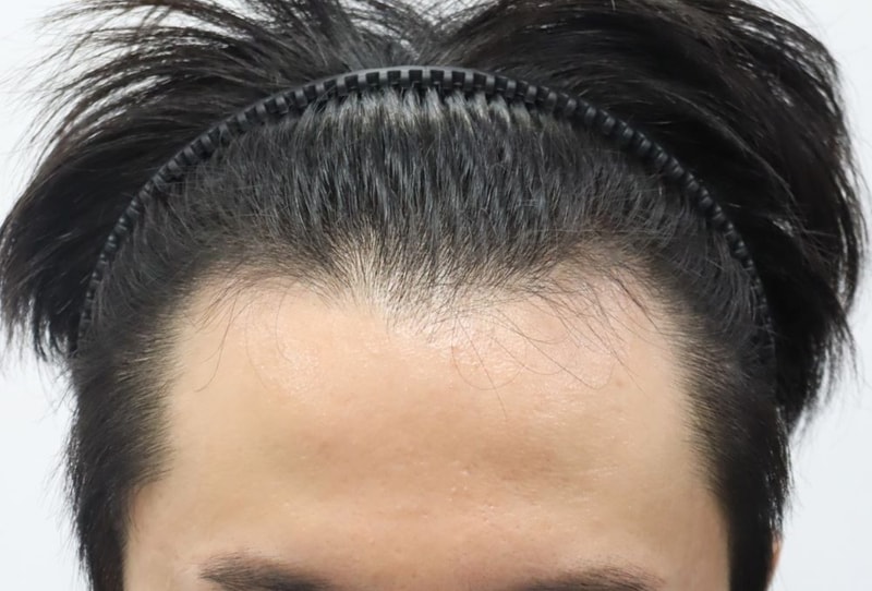 압구정 포헤어의원 앞가마 M자탈모 비절개슬릿 모발이식 1달차 암흑기 후기 (민영기 원장님)