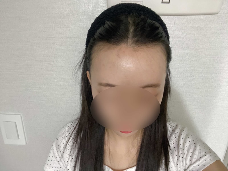 M자 이마 무삭발 비절개 헤어라인 1700모낭 모원성형외과 7달차