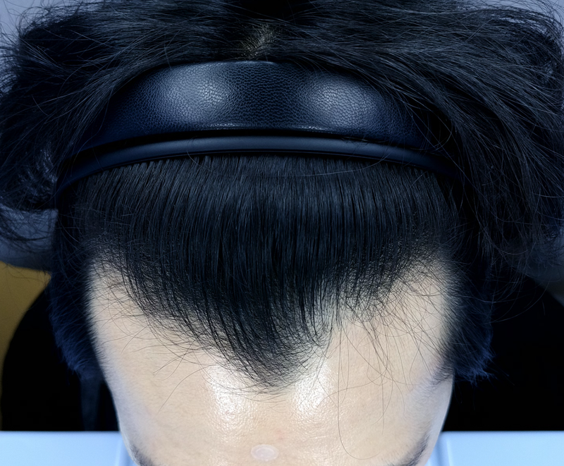남학준95 3500모 이식전.png